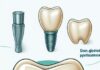 Dental Implants in Vizag